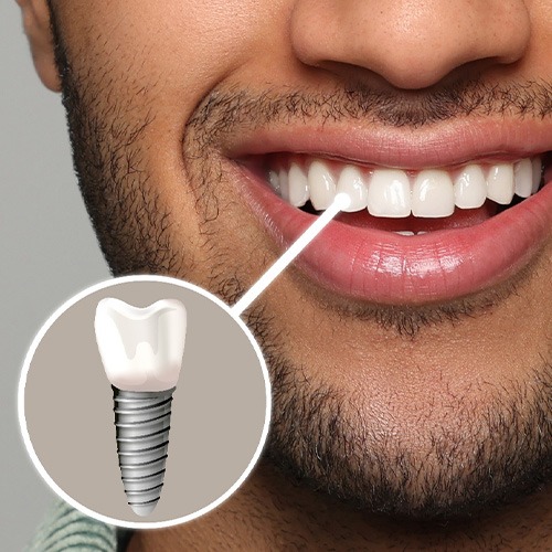 Nose-to-chin view of man smiling with a tooth indicated as implant