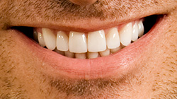 decayed teeth after
