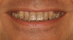 decayed teeth before