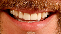smile after