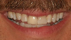 smile before