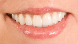 smile makeover after
