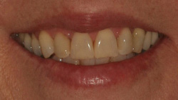 smile makeover before