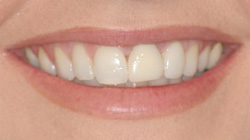 slightly yellow smile before