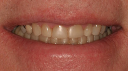 small & yellow teeth before