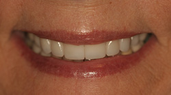 patient smile after