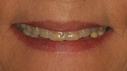 patient smile before