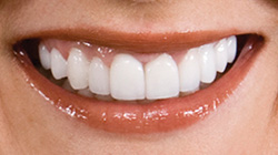 white smile after