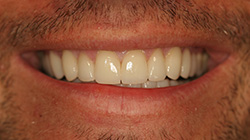 after porcelain veneers