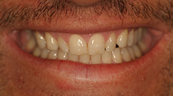 before porcelain veneers