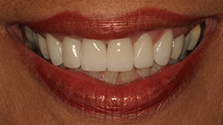 whitened teeth after