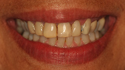 miscolored teeth before