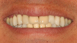 white teeth after