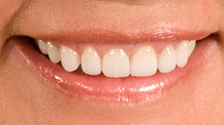 smile after