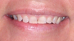 small teeth before