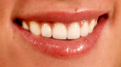 chipped tooth after