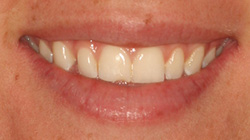 chipped tooth before