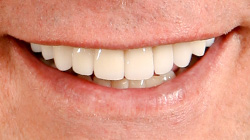 two colored teeth after