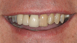 two colored teeth before