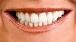 after gum reshaping