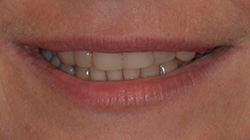before gum reshaping