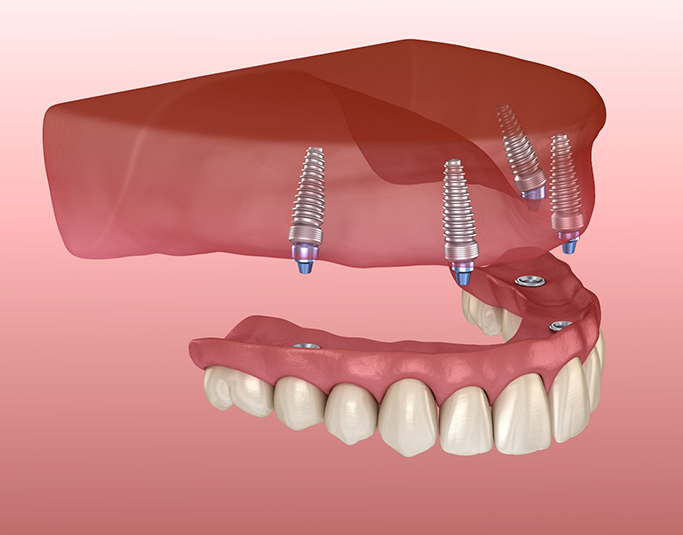 Illustration of a full denture being placed onto four dental implants throughout the jaw