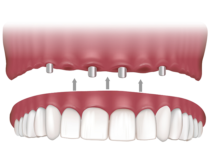 Illustration of a full denture being secured onto four implants