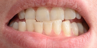 A person in need of Invisalign to fix their crowded teeth