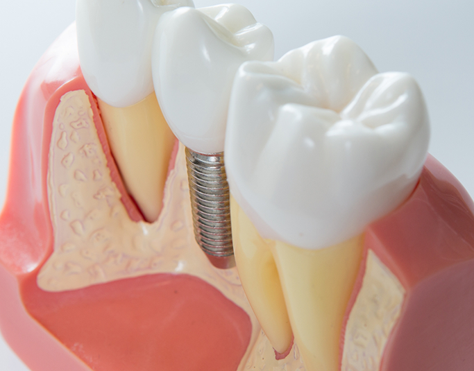 Model of a dental implant between two natural teeth