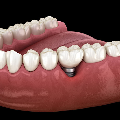 Illustration of a dental implant with a crown replacing a missing tooth
