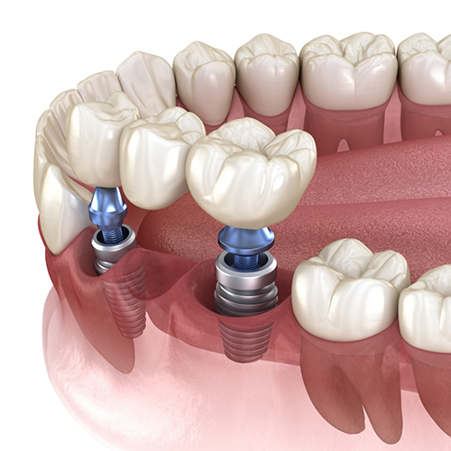 Illustration of two dental implants supporting a dental bridge