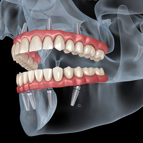 Illustrated x ray of a person with implant dentures replacing all of their teeth