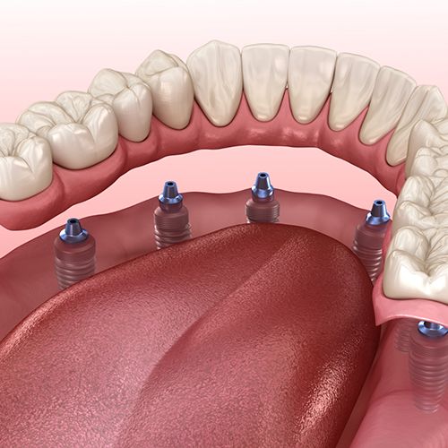 Illustration of a full denture being secured over six dental implants