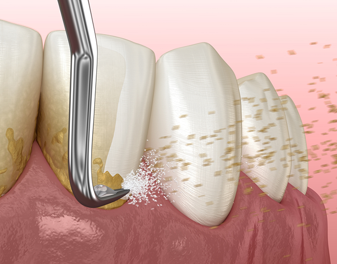 Illustration of a dental scaler clearing tartar buildup from the gums and teeth