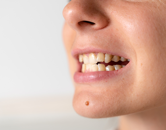 Close up of a mouth with crowded teeth