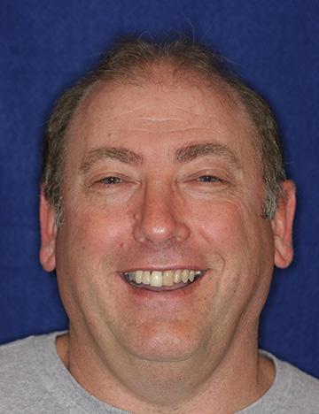 Older man grinning with discolored and uneven teeth