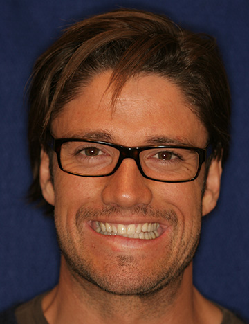 Man with long brown hair smiling with slightly discolored teeth