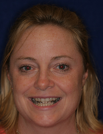 Blonde woman with damaged teeth smiling