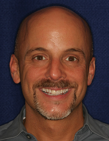 Bald man smiling with slightly stained and misaligned teeth