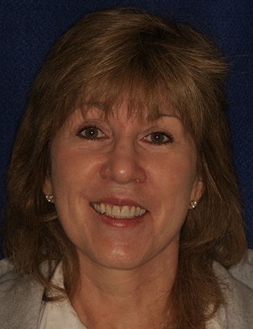 Blonde woman with yellowed teeth smiling