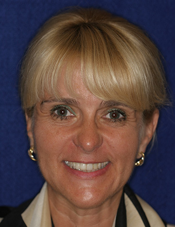 Smiling blonde woman with slightly darkened teeth