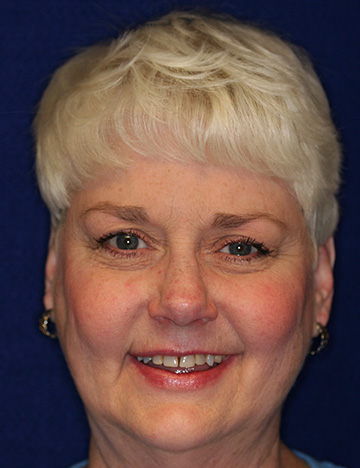 Woman with short blonde hair smiling with discolored and gapped teeth