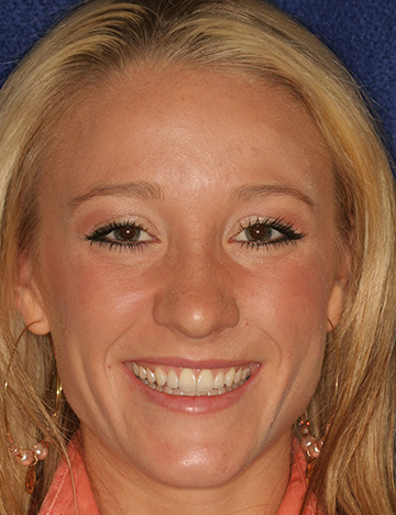 Young woman grinning with slightly yellowed and uneven teeth
