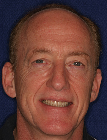 Smiling older man with yellowed teeth
