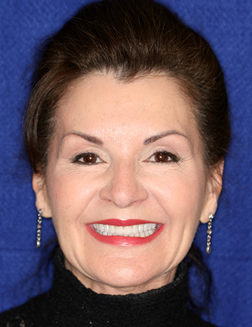 Brunette woman smiling before cosmetic dental treatment