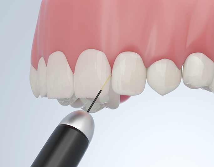 Illustration of a dental laser treating the gums