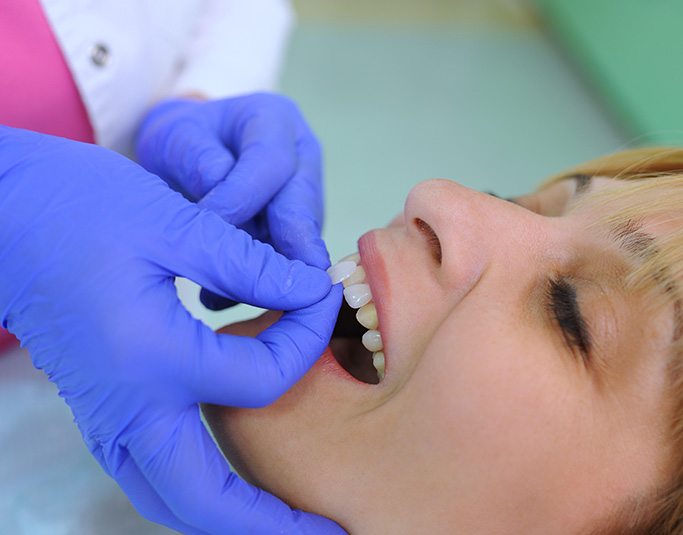 The process of getting veneers begins with a consultation at Windermere Dentistry