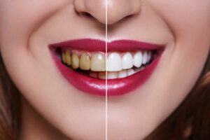 A before and after photo of a woman’s smile