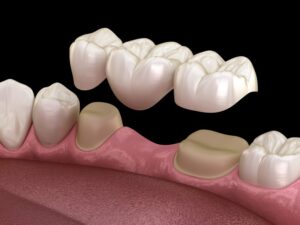 Animated model of dental bridge. 