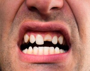 Patient opening his mouth to reveal broken tooth
